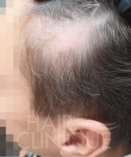 Mikropigmentacja skóry głowy w łysieniu plackowatym